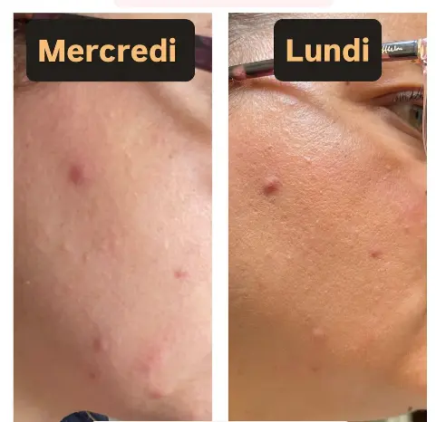 avant - après fanny facialiste